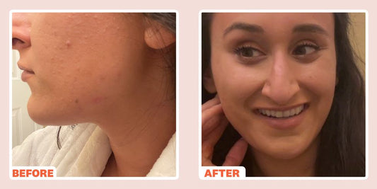 Check Out our latest feature in Women's Health...‘How I Cleared My Skin When I Learned PCOS Was Causing My Cystic Acne’ - Realm Concept Market